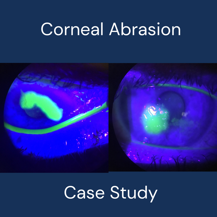 How to treat corneal abrasion/scratch – Optiplex Children's Eyecare