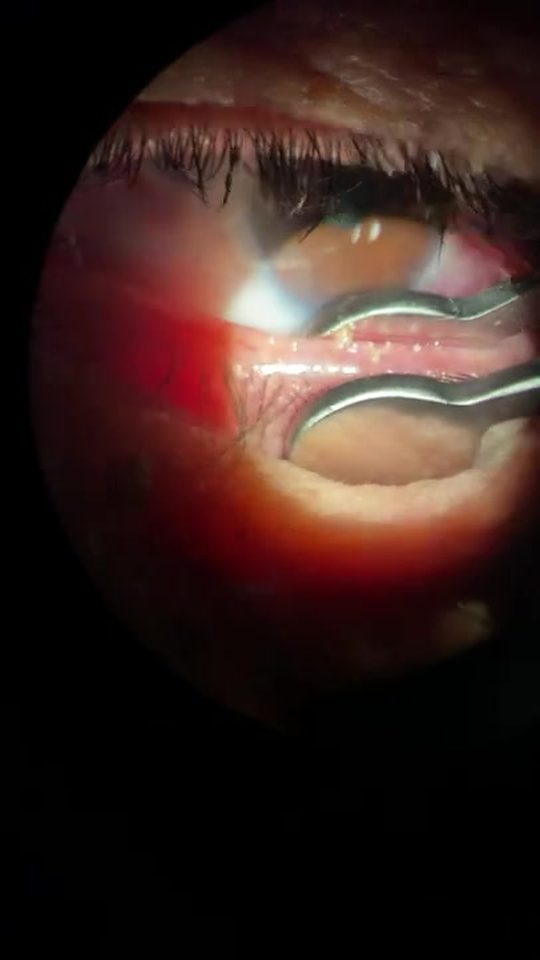 Close-up of an eyelid having its oil glands expressed under the microscope